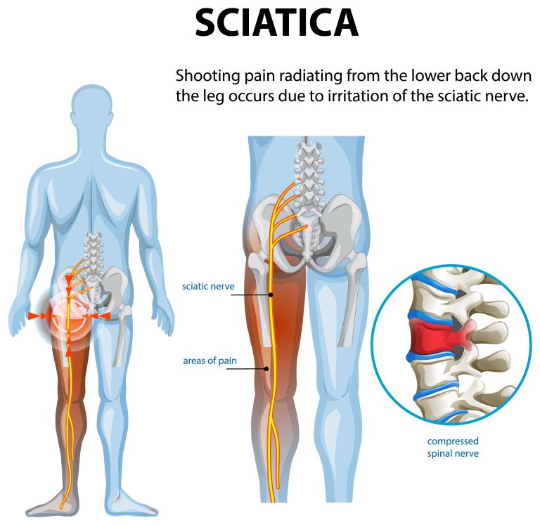 Schéma médical de la sciatique montrant le nerf sciatique, la zone de douleur irradiant du bas du dos jusqu’à la jambe, et un nerf spinal comprimé.